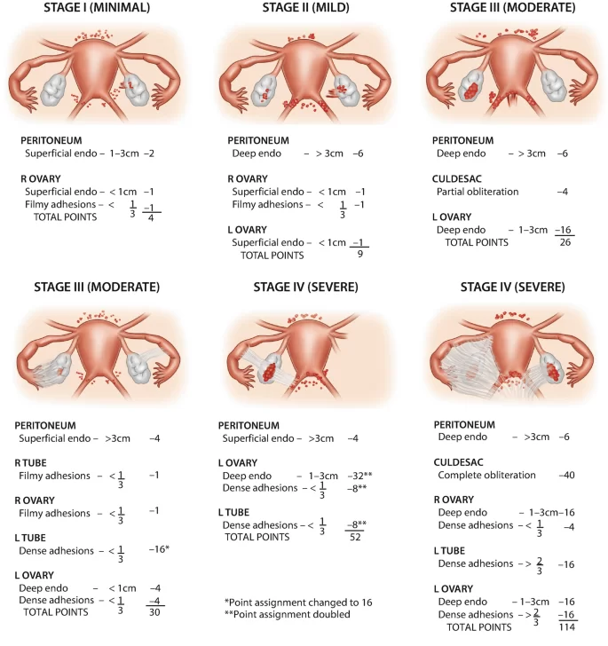 Medical illustration showing Stage I, II, III, and IV endometriosis