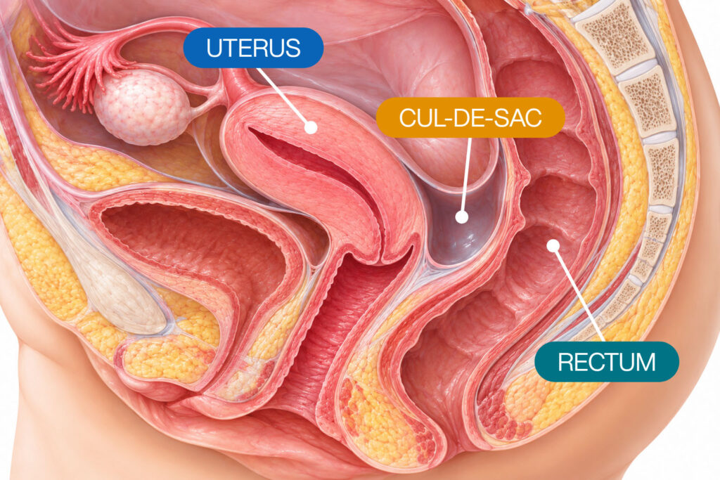 Medical illustration showing the uterus, rectum, and cul-de-sac (pouch of Douglas), the space located between the uterus and rectum.