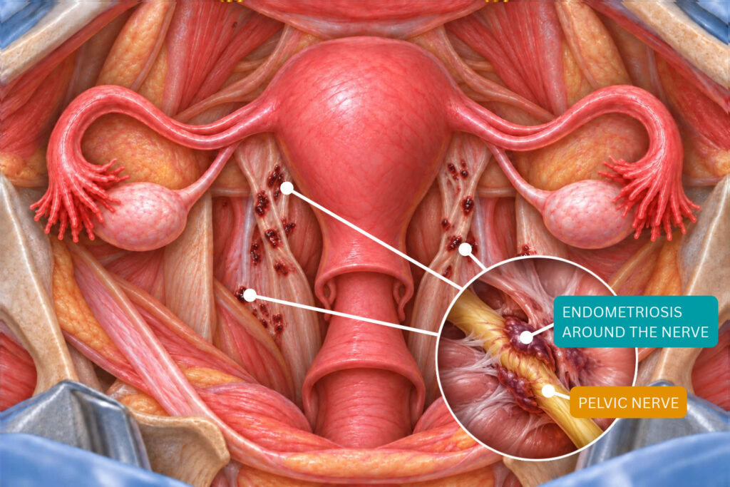 Medical illustration showing endometriosis lesions affecting pelvic nerves.