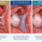 Adhesion Barriers After Endometriosis Surgery: How Do They Work?