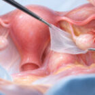 Endometriosis Surgery and Fertility: The Role of Adhesion Barriers