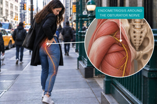 Inner Thigh Pain During Your Period: Could It Be Endometriosis?