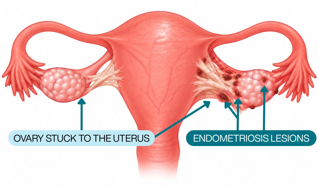 Medical illustration showing ovaries stuck to the uterus by pelvic adhesions, with endometriosis lesions on the right side.