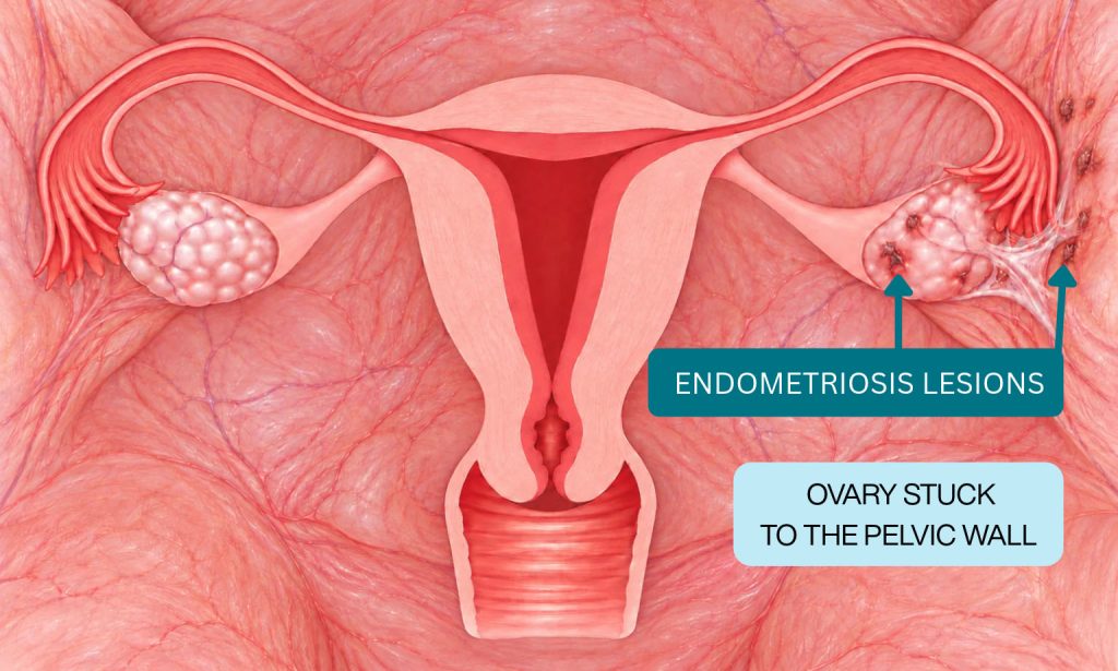 Medical illustration showing ovaries stuck to the uterus by pelvic adhesions, with endometriosis lesions on the right side.
