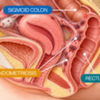 Sharp Rectal Pain During Your Period and Endometriosis