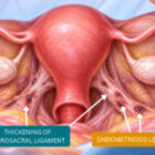 Uterosacral Ligament Thickening and Deep Endometriosis