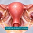 Bilateral Endometriomas and Their Impact on Ovarian Health