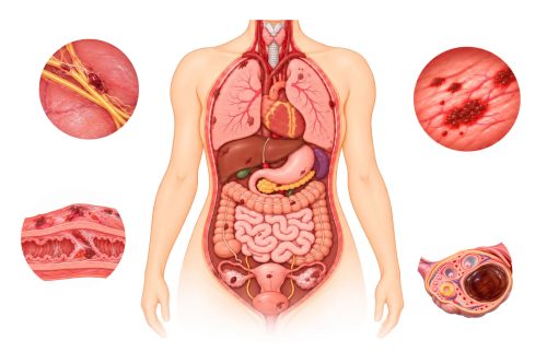 Endometriosis in Other Organs: Symptoms and Complications