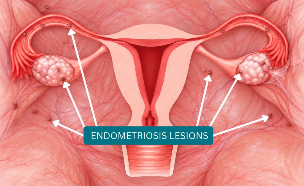 Medical illustration showing dark reddish-brown endometriosis lesions affecting the uterus, ovaries, and surrounding pelvic tissues.