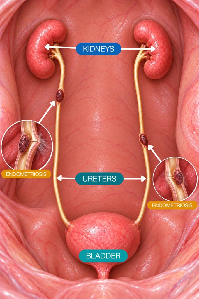 Medical illustration of ureteral endometriosis compressing the ureter and causing hydronephrosis in the kidney.